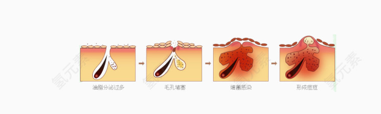 痘痘形成过程矢量