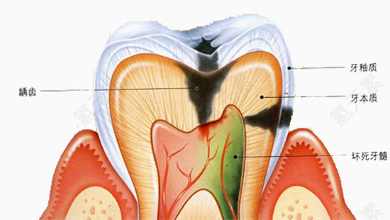 蛀牙原理