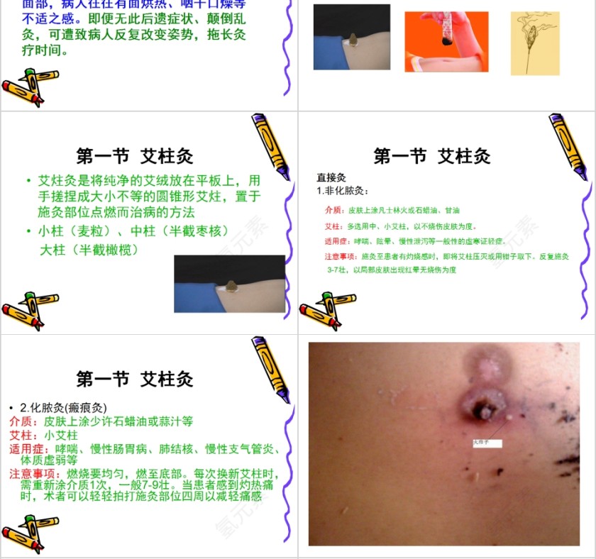 中医灸法学培训PPT第4张