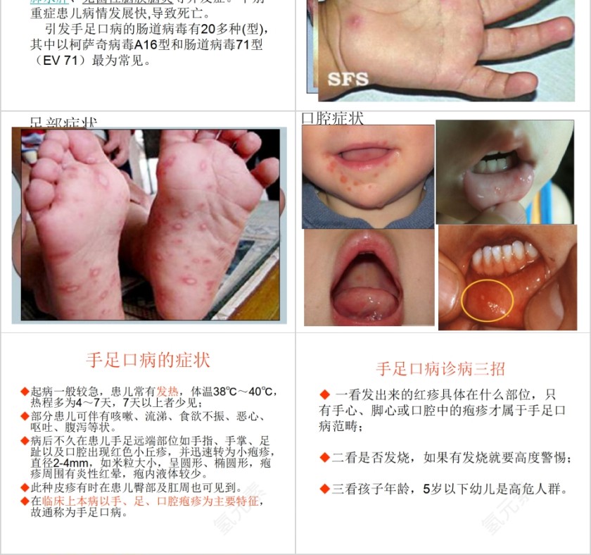   讲究卫生远离手足口病预防传染病主题班会PPT模板第2张