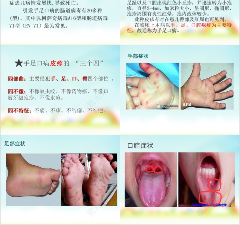 让孩子远离手足口病预防传染病手足口病主题班会模板第2张