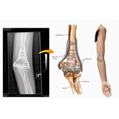钢钉螺丝接骨手术