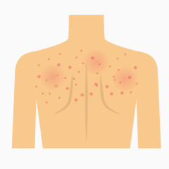 卡通背部痤疮