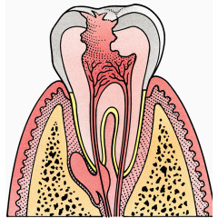 龋齿牙根插图