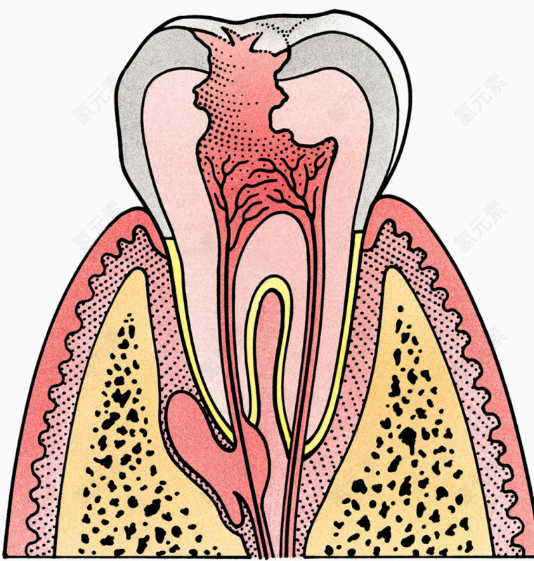 龋齿牙根插图