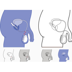 结扎手术示意图