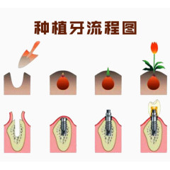 种植牙流程