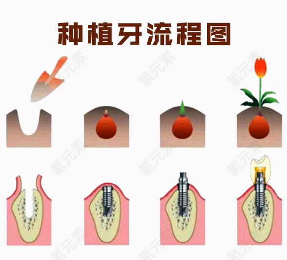 种植牙流程