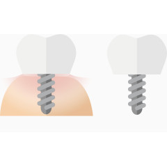 牙医镶牙解析图