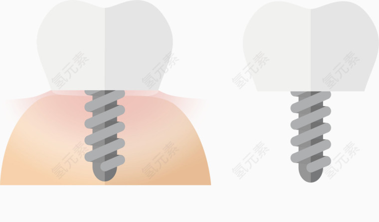 牙医镶牙解析图