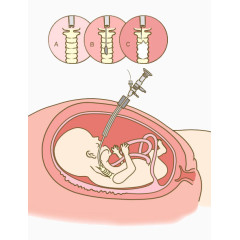 胎儿的手术