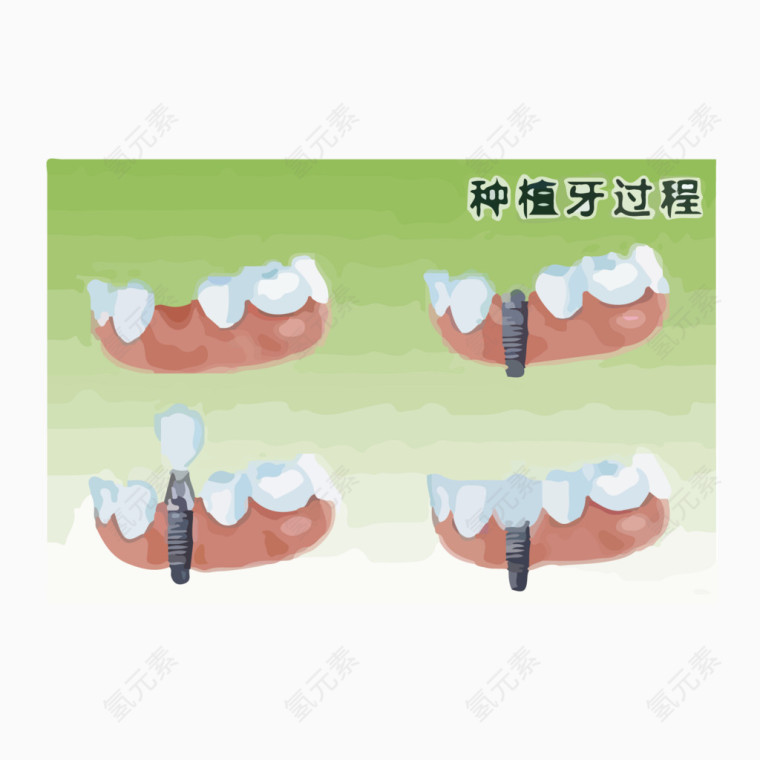 种植牙过程图