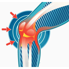 膝关节发炎插图