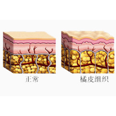 橘皮组织