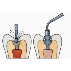 牙根手术插图