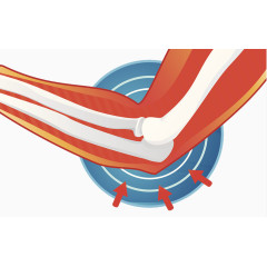 肘关节发炎插画