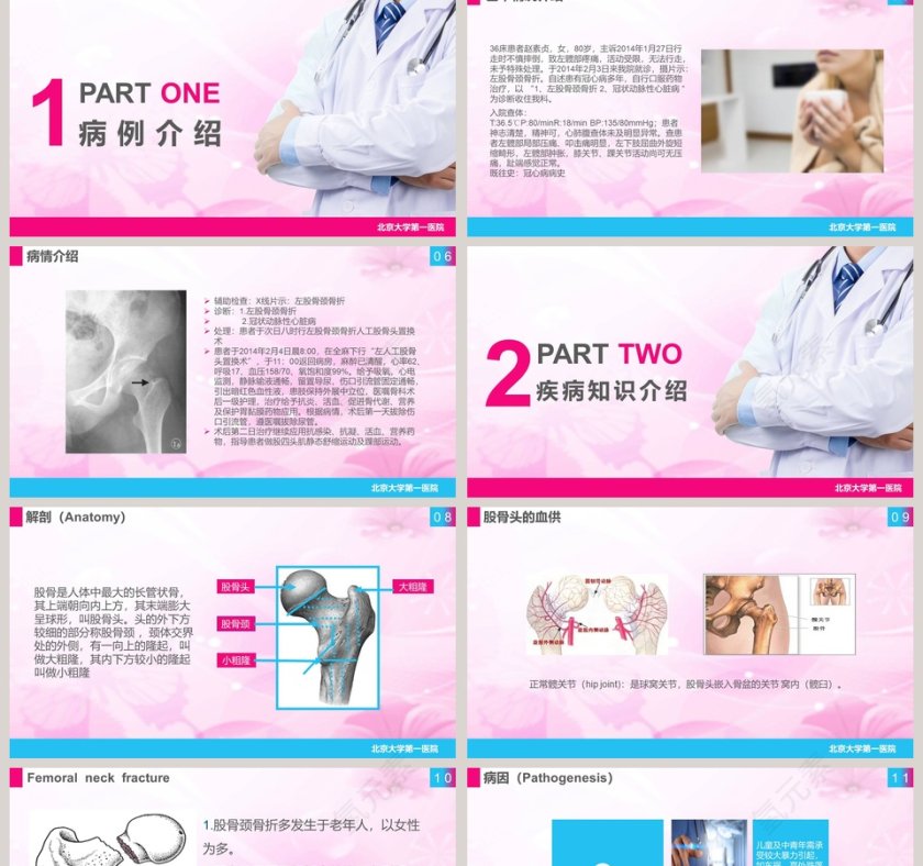 股骨颈骨折护理查房课件PPT第2张