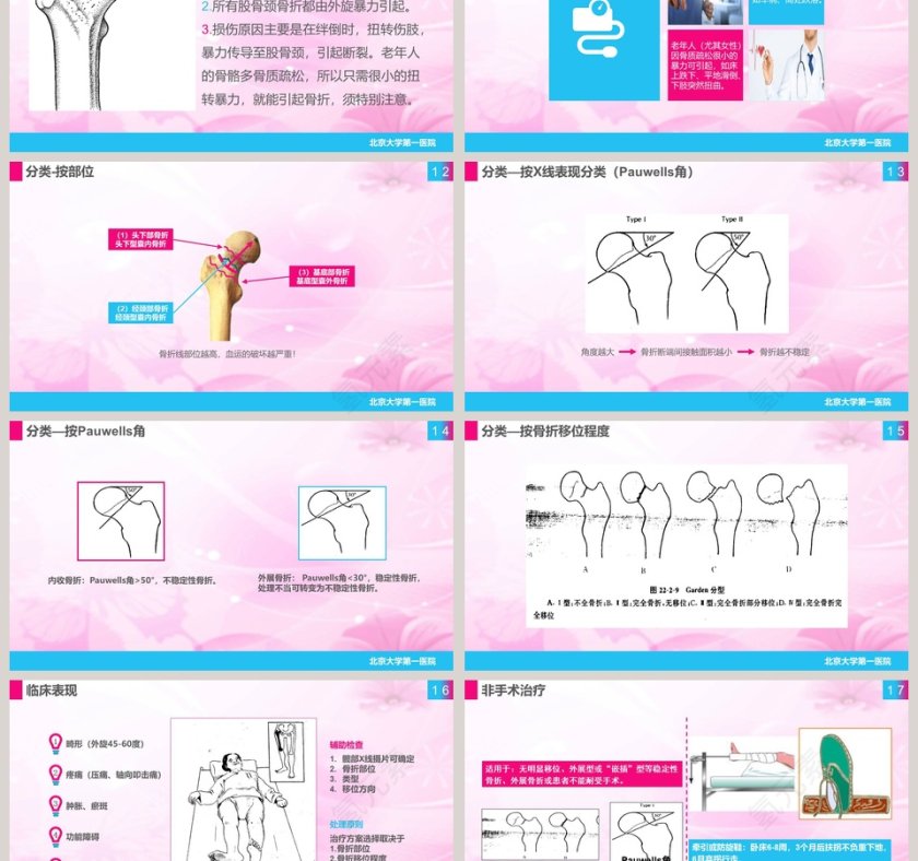 股骨颈骨折护理查房课件PPT第3张