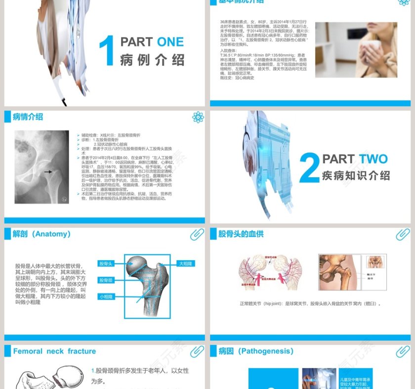 股骨颈骨折护理查房课件PPT第2张