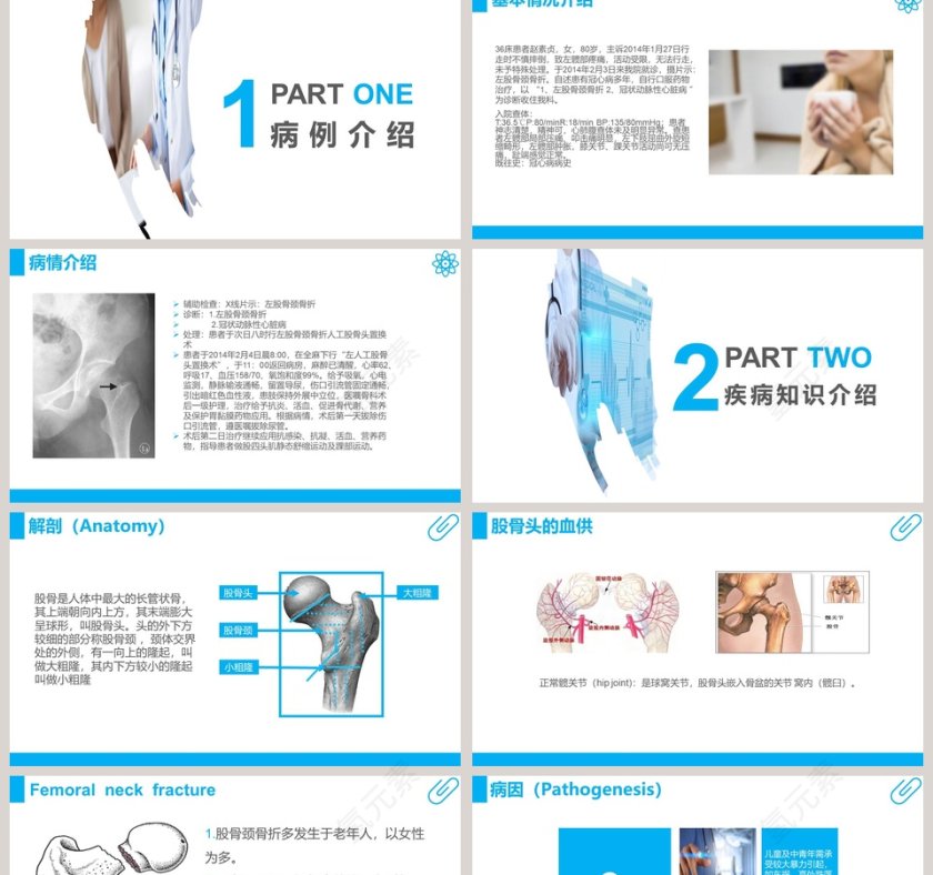 股骨颈骨折护理查房ppt 第2张