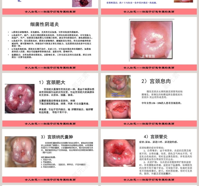 妇科疾病知识讲座PPT模板第4张