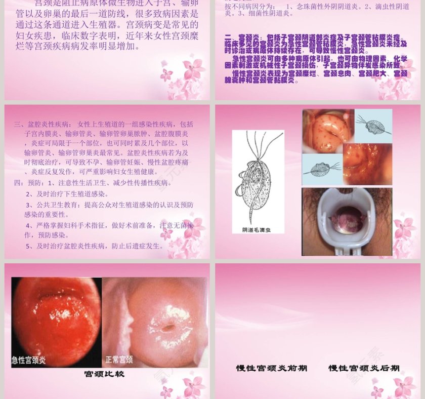 粉色简约妇科常见疾病知识讲座PPT模板第5张