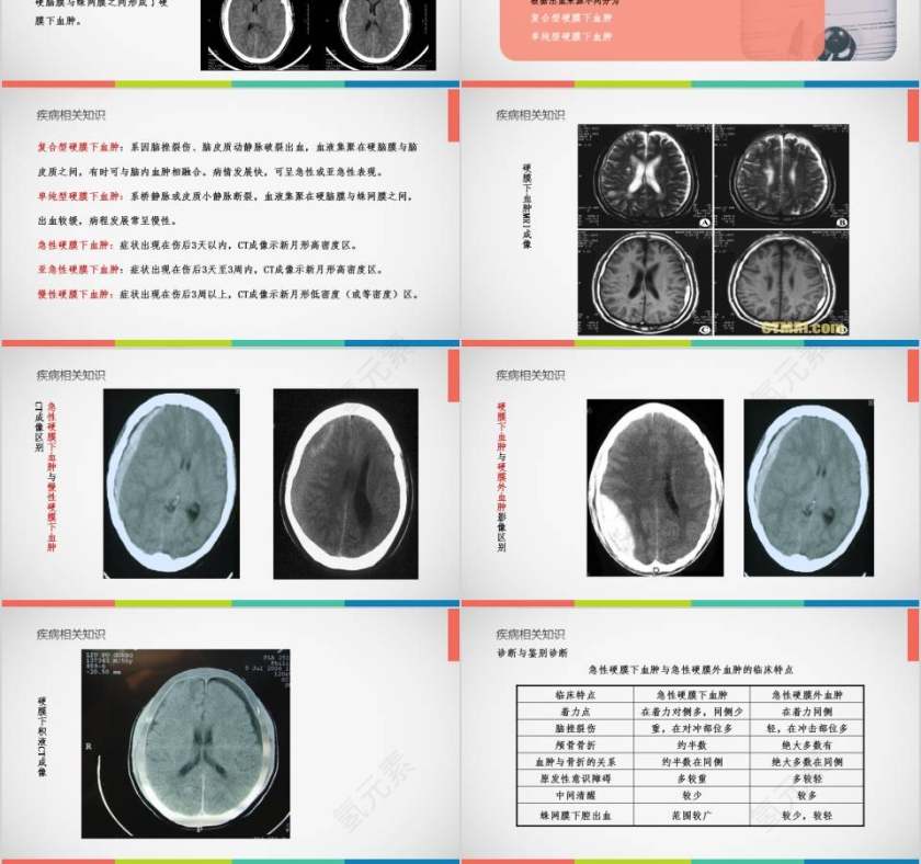 亚急性硬膜下血肿护理查房PPT 第3张