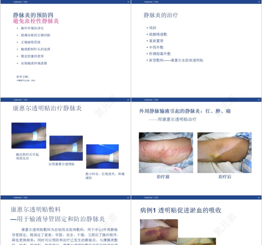 静脉输液的血管保护和周围皮肤护理PPT模板第5张