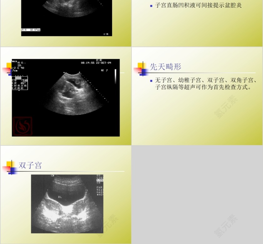 简约清新妇科常见疾病知识PPT模板第16张
